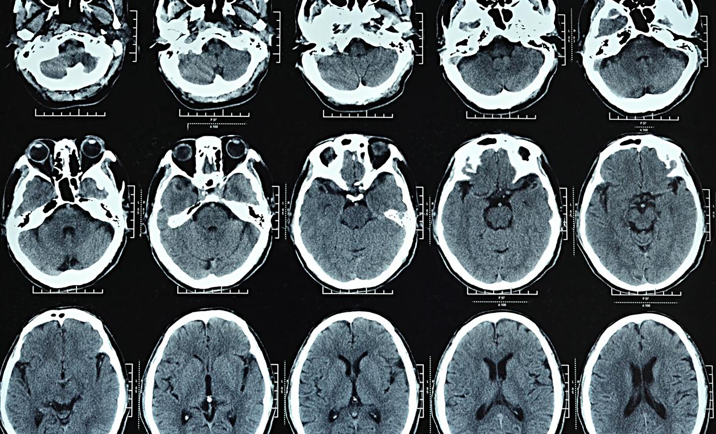 การถ่ายภาพรังสีด้วยเครื่องเอกซเรย์คอมพิวเตอร์(CT)