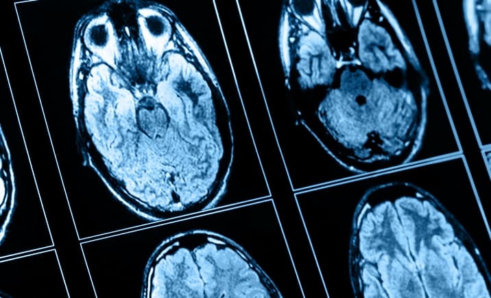 neurological scale